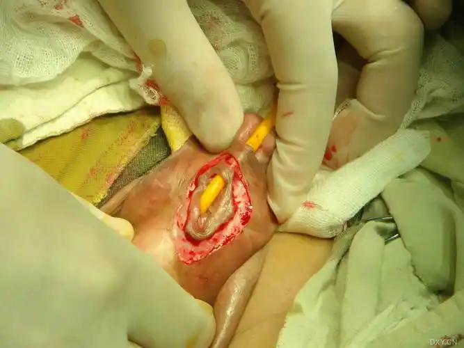 【资料】尿道下裂术后尿瘘手术照片