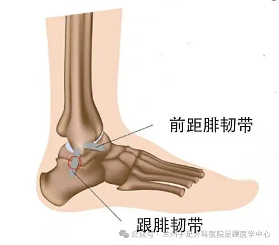 一文解读急性踝关节内翻扭伤及慢性外侧不稳定一
