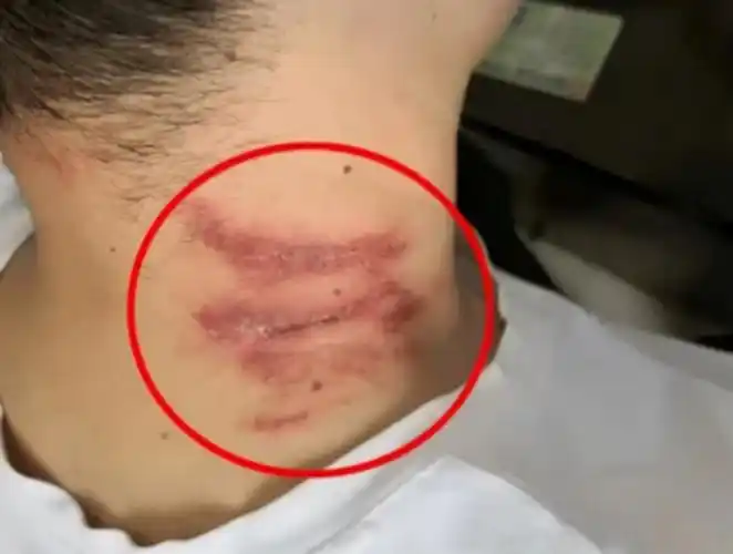 隐翅虫皮炎初期图片(被隐翅虫咬伤急救指南) - 赤虎壹号