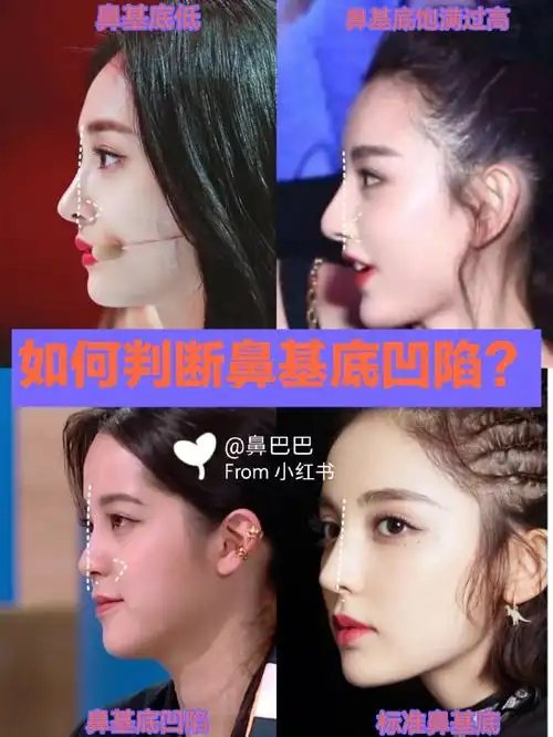 如何判断鼻基底凹陷