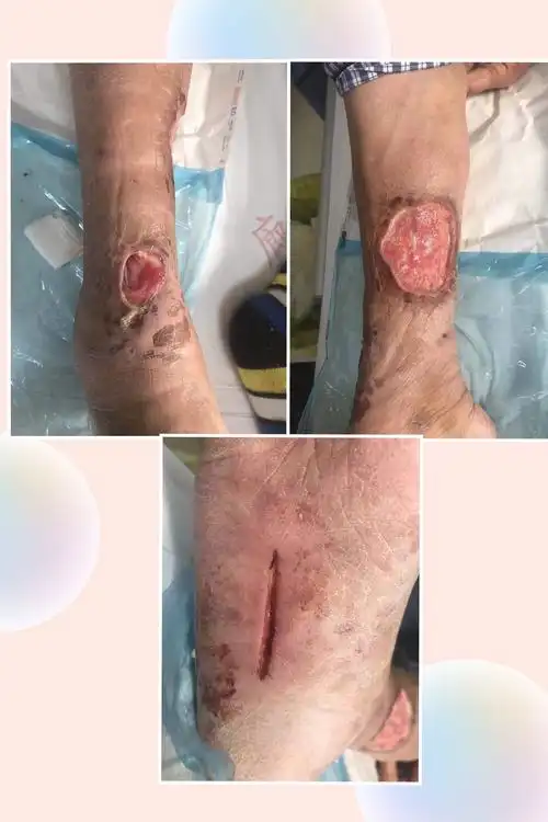 23患者女,66岁,右小腿化脓感染2月,由廊坊市人民医院血管介入外科清创