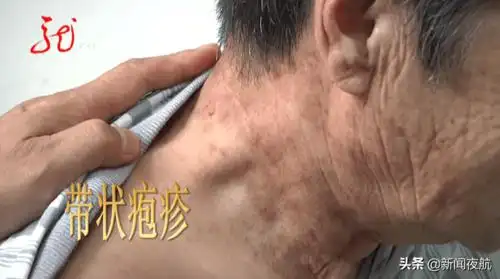 疱疹分别长在了两位老人的脖子和头上,只要病情发作起来,那种感觉没法