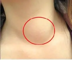 首页 甲状腺瘤 甲状腺瘤症状    良性甲状腺瘤:患者一般无明显症状.