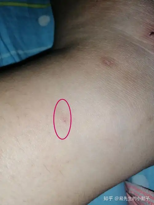 有人知道蝙蝠咬了之后咬痕是什么样子的吗