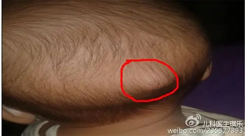 宝宝淋巴结肿大是怎么回事?