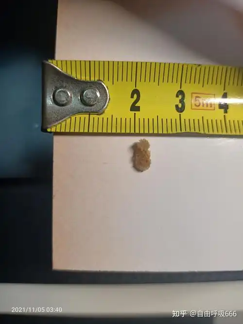 7mm肾结石39天曲折排出经过