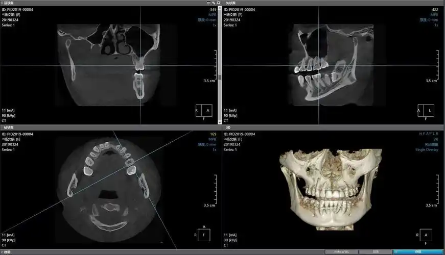 四川大学华西医院龙泉医院超大视野口腔ct投入使用