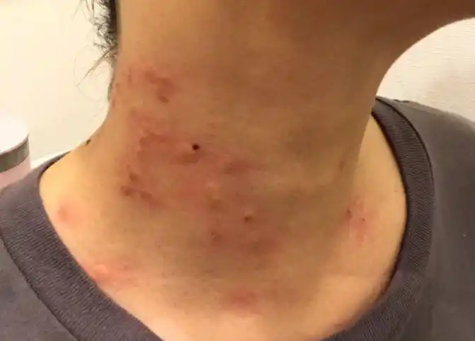 27岁男子疯玩染hpv使妻子脸上长满痘痘医生怒斥没常识这是也能做