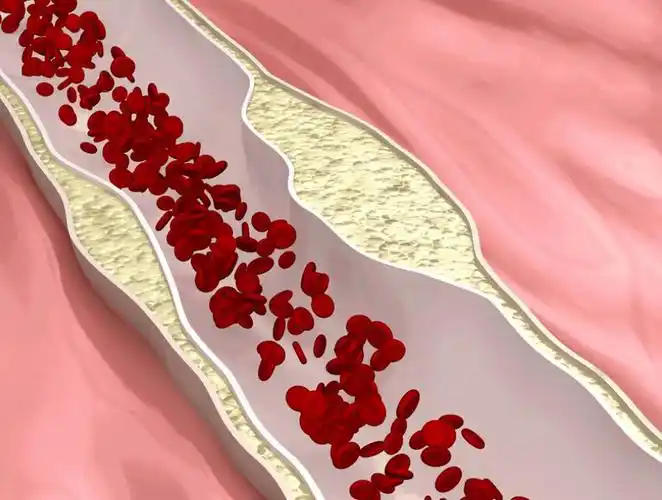"小"斑块蕴含"大"危险