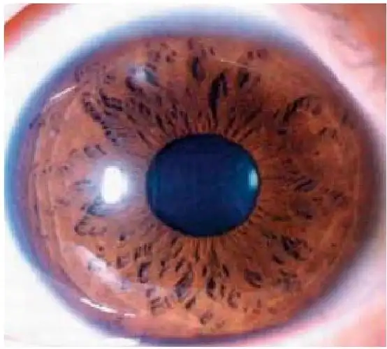 虹膜纤维结构与身体素质和体质分型