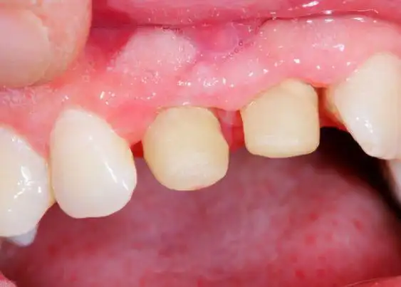 做烤瓷牙为什么要磨牙?可以不磨牙吗?好好的牙齿磨掉多可惜