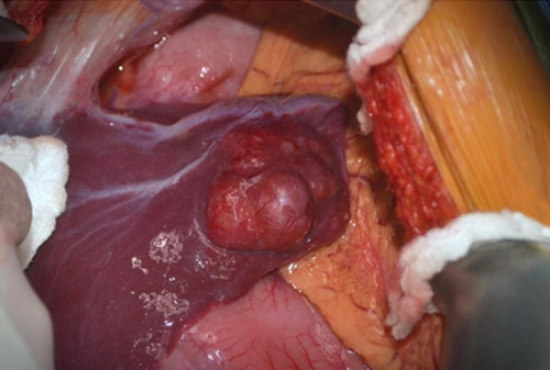 有图有真相图解7种常见肝脏肿瘤良性篇