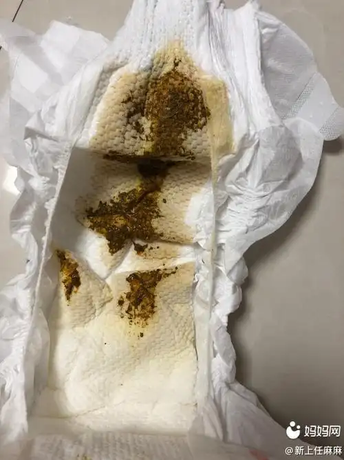 宝宝拉的水便分离图片