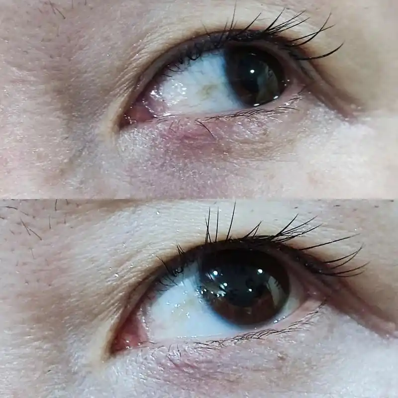 睑裂斑怎么袪除?眼白上面长得这个东西,不叫黄斑,而是叫做睑裂斑!