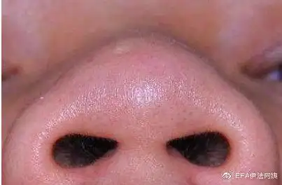 为什么医生都不愿意单独做鼻翼缩小?那大鼻头宽鼻翼怎么办?