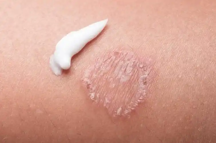 体癣患者别大意,这些症状需及时处理!