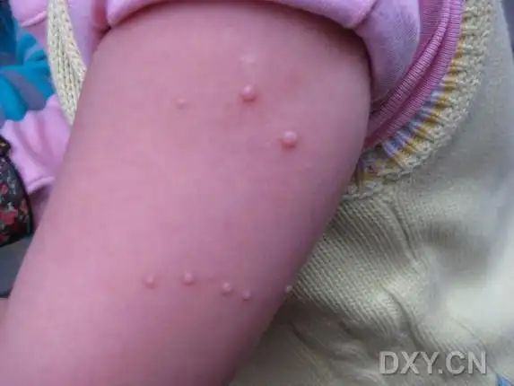 【请教】传染性软疣的治疗 - 皮肤性病 -丁香园论坛