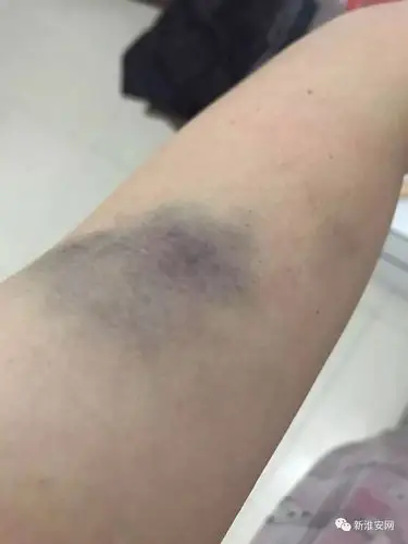 死者生前被打淤青照片流出淮安26岁妈妈携儿喝农药身亡这事不简单