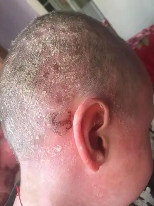 9岁男孩患有严重皮肤病,医生无能为力,他说自己宁愿死也不想活