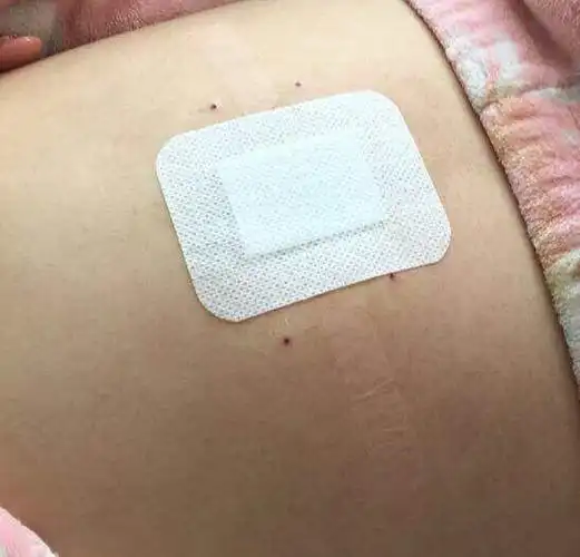 急性单纯性阑尾炎腹腔镜术后的护理措施