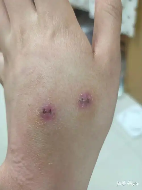 伤口处红肿,略瘙痒,可以看到缝线处已经有结痂.