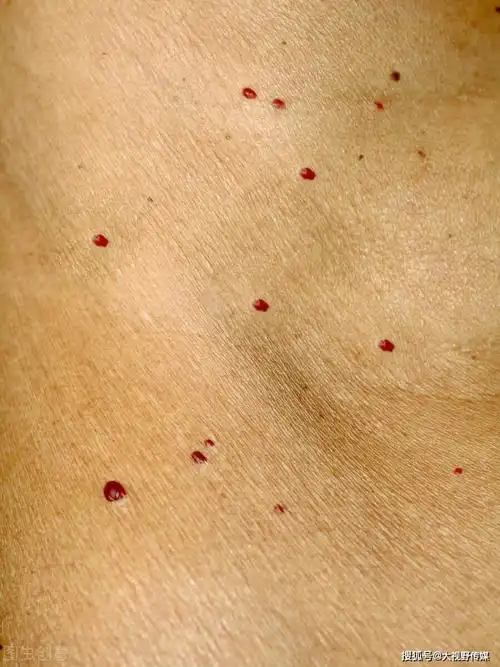 长红痣,是肝病的标志吗?在中医眼中,还有这2种原因,不妨看下