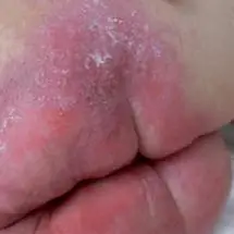 处理失禁性皮炎劝你别用爽身粉