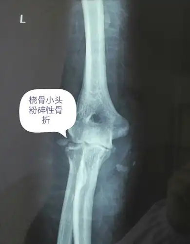 桡骨小头粉碎性骨折术前