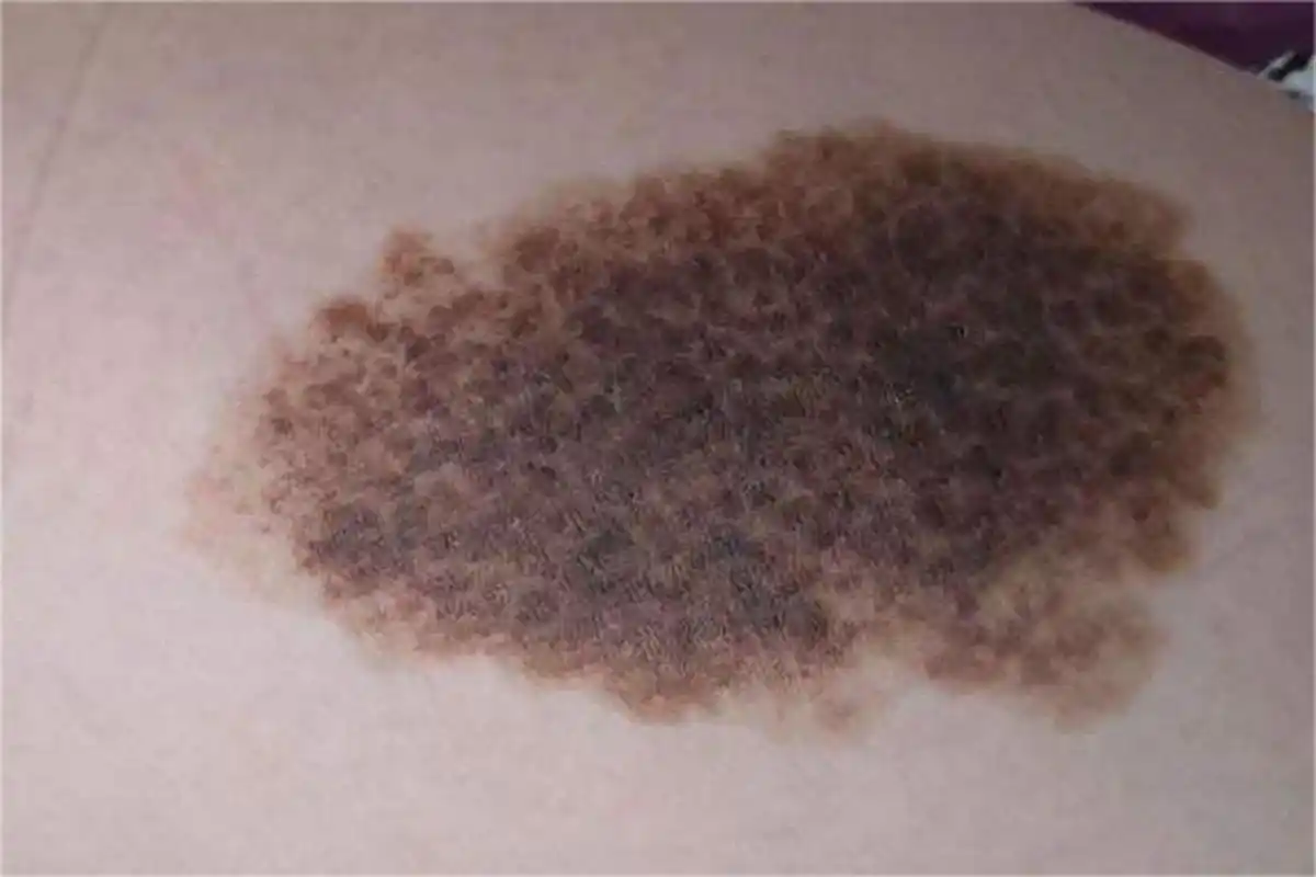 满意!去掉胎记大概要多少钱"笑逐颜开"-第1张图片-康峰博客