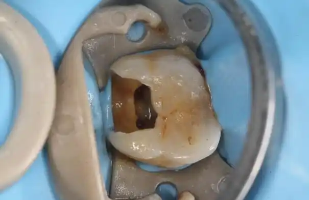 上牙第一颗臼齿烂透了只剩半个发黑牙外壳有必要拔牙吗