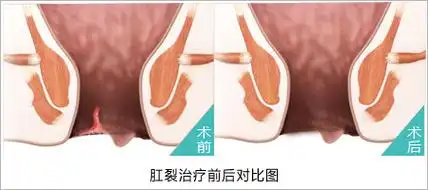 如何确定肛裂的症状?