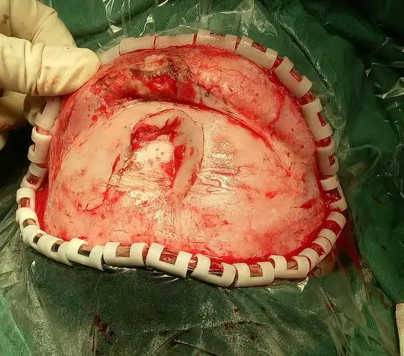 额顶部颅骨凹陷性粉碎性骨折一例