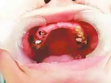 法国男子只给孩子喝可乐获刑3个月4岁儿子牙齿被糖蛀烂拔掉7颗