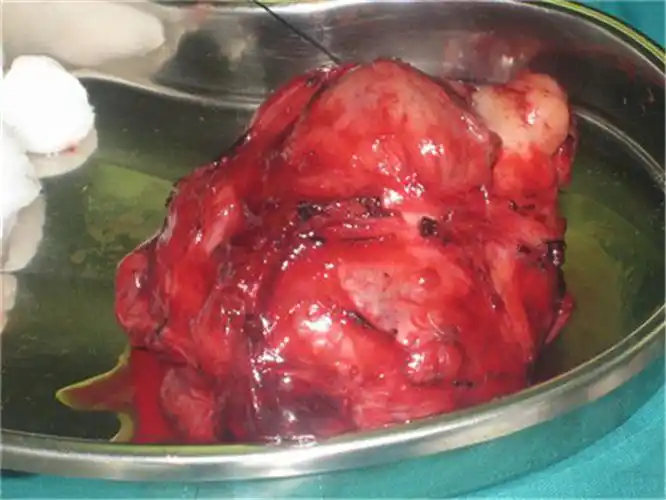 东区肿瘤专家_东区治疗肿瘤哪个专家好_东区治疗肿瘤最好的专家/排行