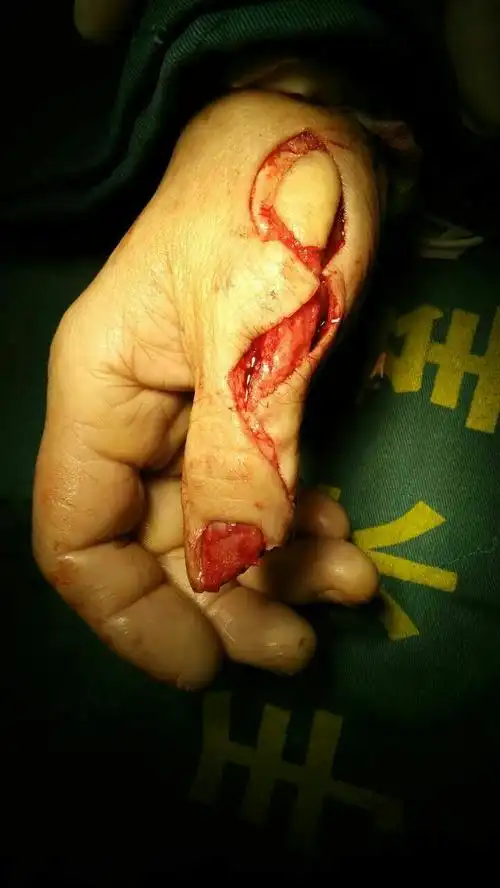 【2017年5月7日】女,60岁,右拇指末节部分毁损伤清创探查皮瓣修复术