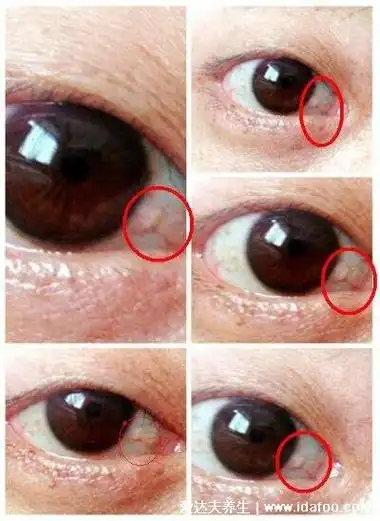 眼睛睑裂斑图片症状,眼白上有不痛不痒的淡黄色斑块