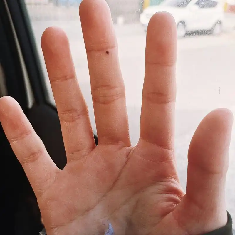 大概是高二的时候,右手中指突然长了个痣.