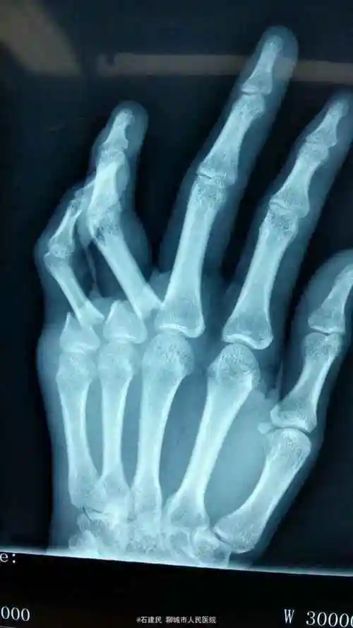 指骨骨折