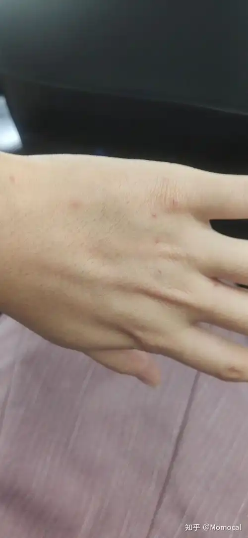 最近身上又长了几个红点像血点以前只有一个而且消不下去