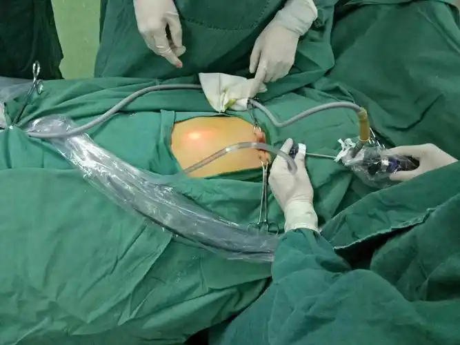 腹腔镜下"单孔法(3—5mm)"治疗小儿疝气及鞘膜积液