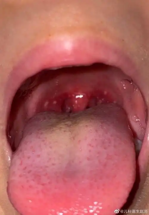 诊间日记##疱疹性咽峡炎