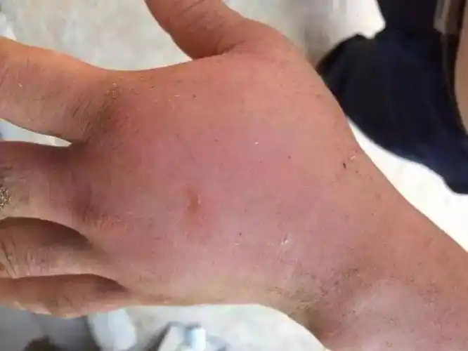 钦州一男子被眼镜蛇咬伤,手臂肿胀惊人!