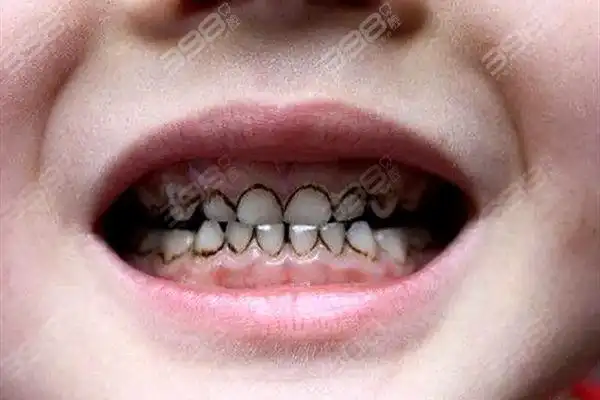 喝可乐对牙齿的影响图片揭开真相-口腔医院新闻-398口腔网