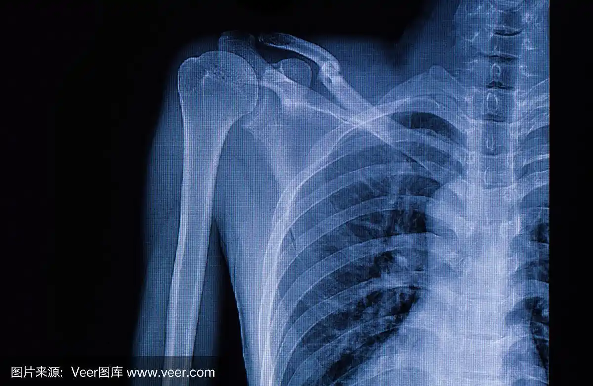 左锁骨骨折x线照片