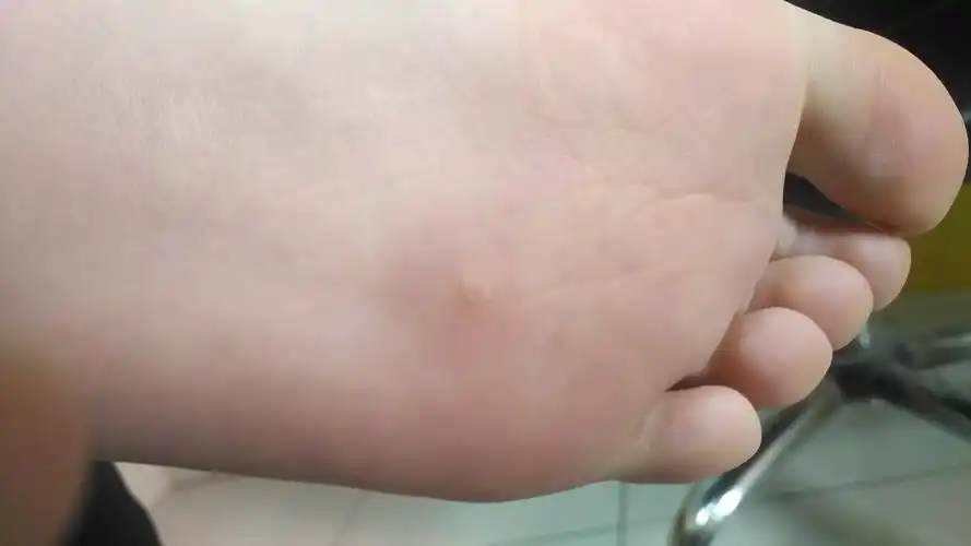 病毒疣15:足底跖疣,除了冷冻还有别的选择吗?