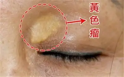 睡眠不好,容易忘事,还觉得手脚发麻,沉重,这可能是在提醒你血脂偏高了