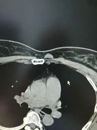 女性,54岁,胸骨柄突起畸形数年,偶尔疼痛