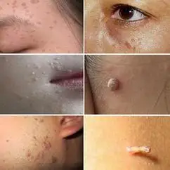 女性尖锐湿疣的症状都有哪些特征,怎么判断得了尖湿锐尤