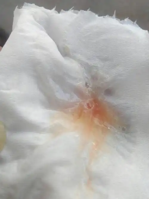 痰(鼻涕)里有血怎么回事啊?