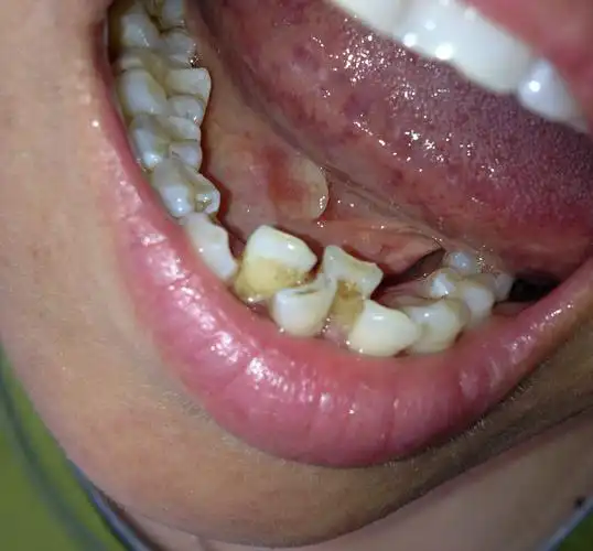 问:吃饭时舌头下面磨个紫血泡,血泡破了之后就没管它,两天之后刷牙